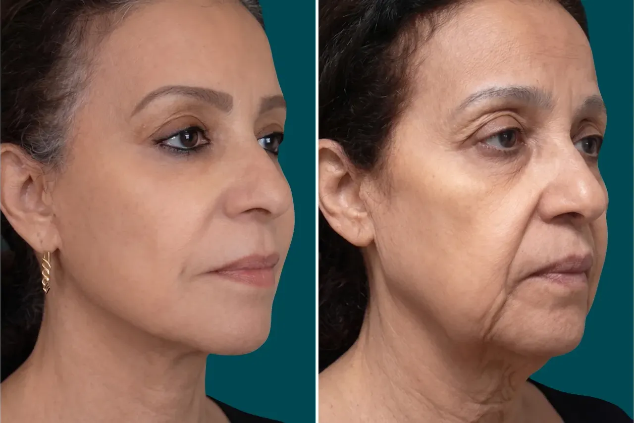 Facelift Before and After 10
