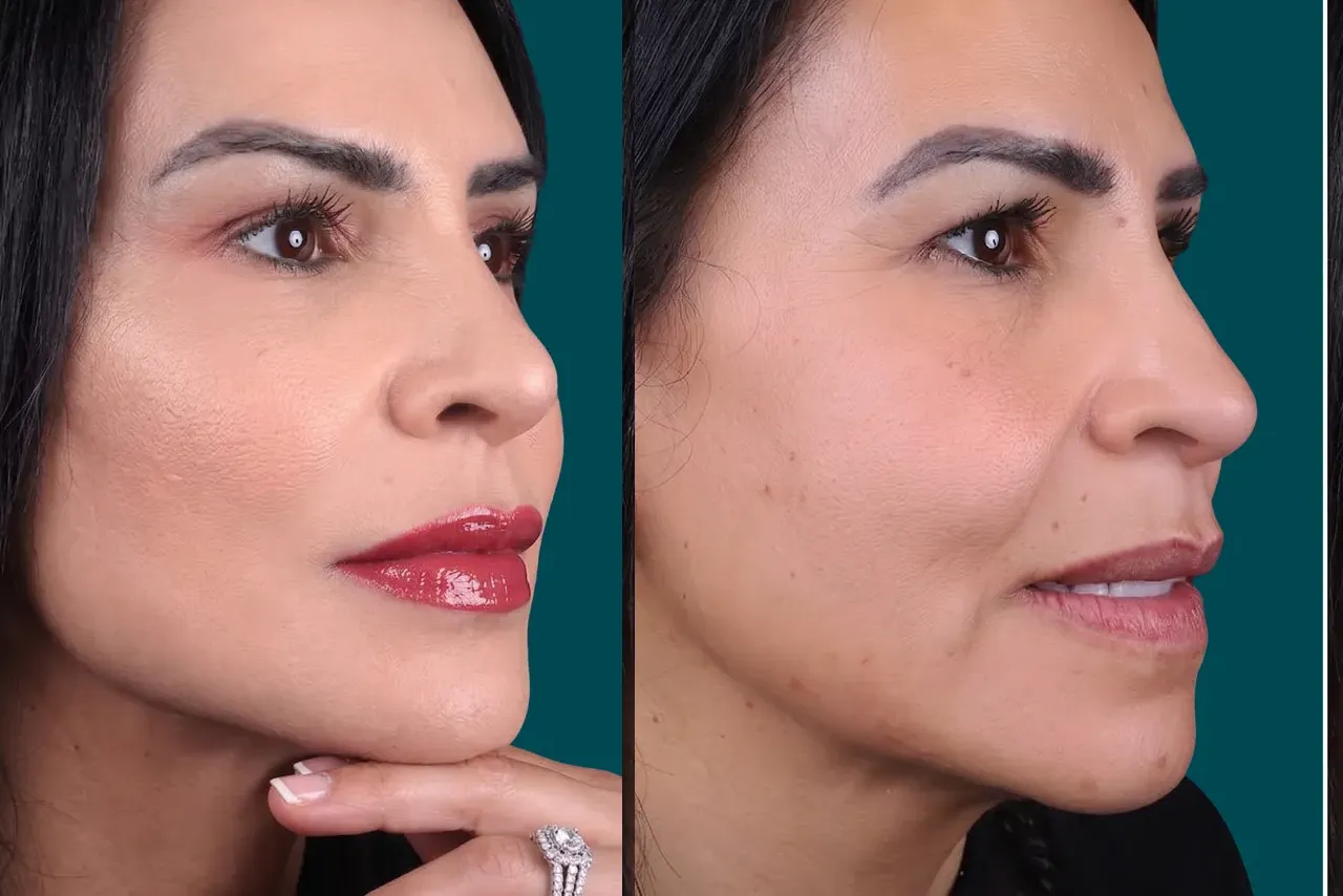 Facelift Before and After 2