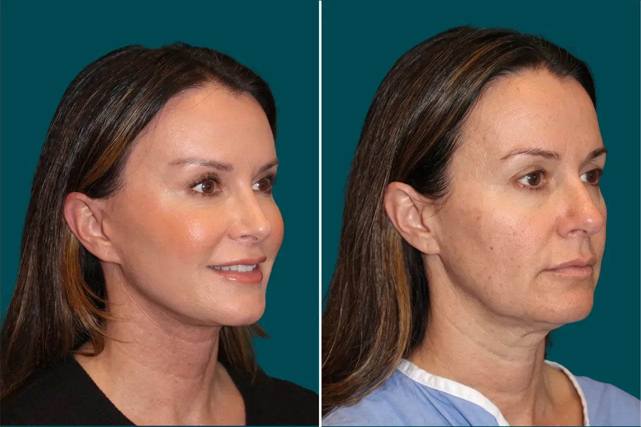 Facelift Before and After 3