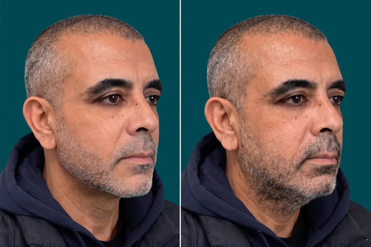Facelift Before and After 4
