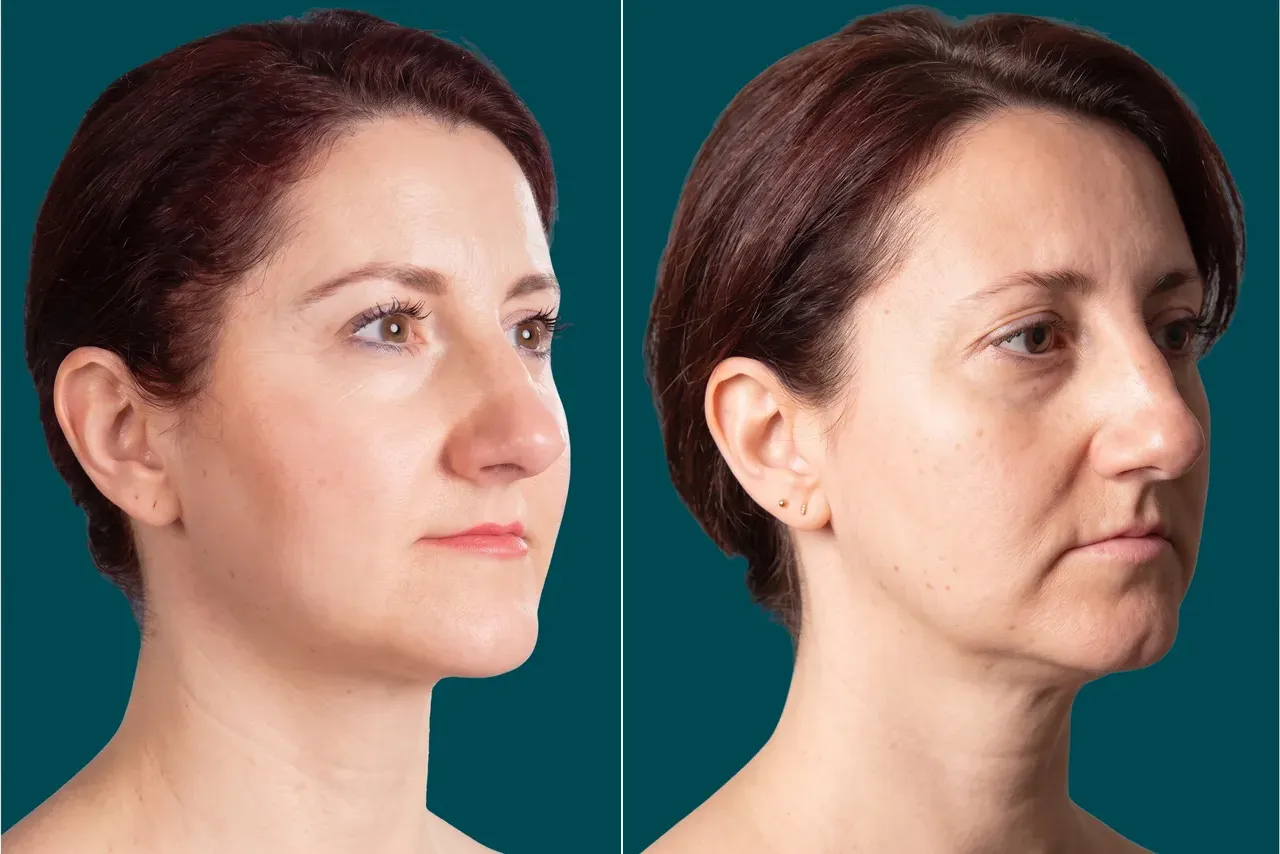 Facelift Before and After 5