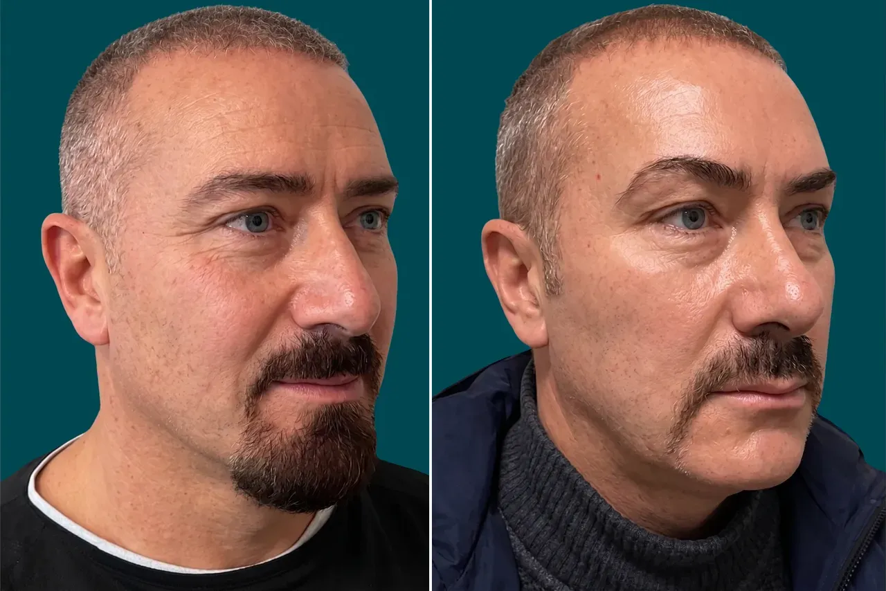 Facelift Before and After 6