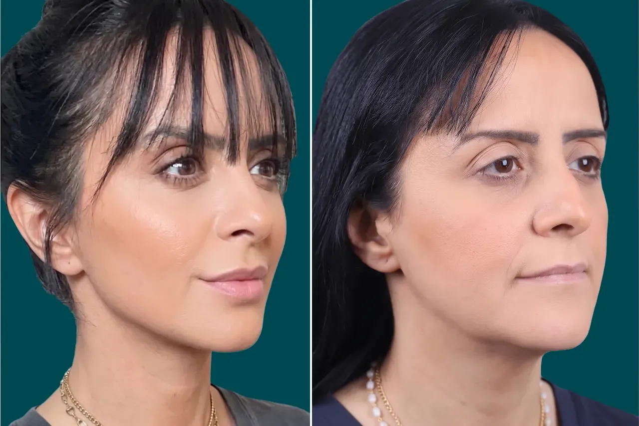 Facelift Before and After 7