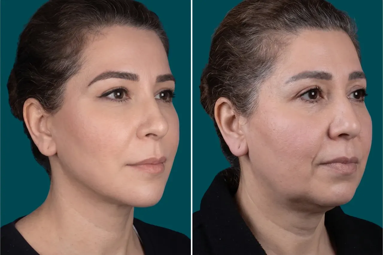Facelift Before and After 8