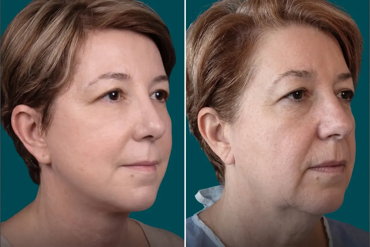 Facelift Before and After 9