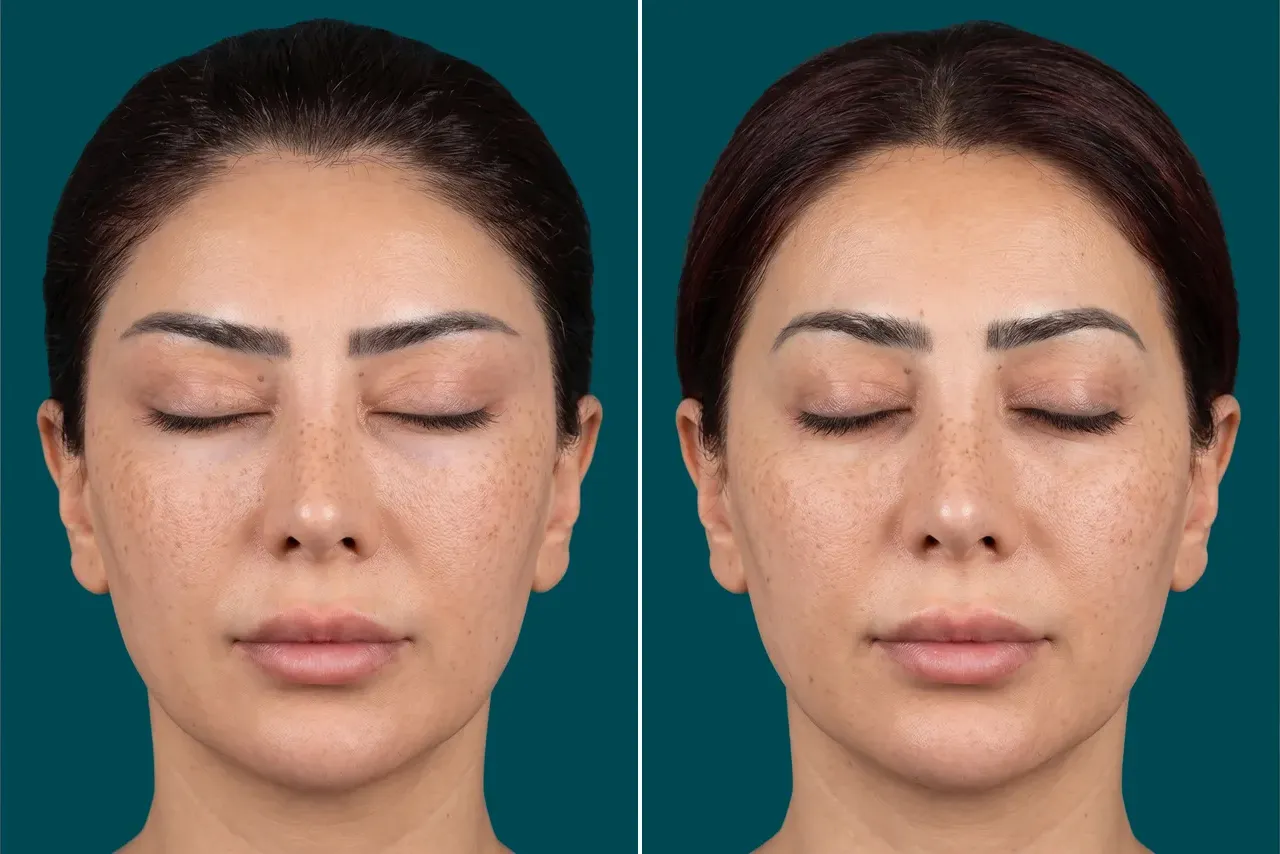 Fox Eye Lift Before and After 1