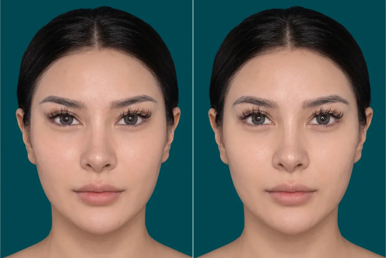 Fox Eye Lift Before and After 2
