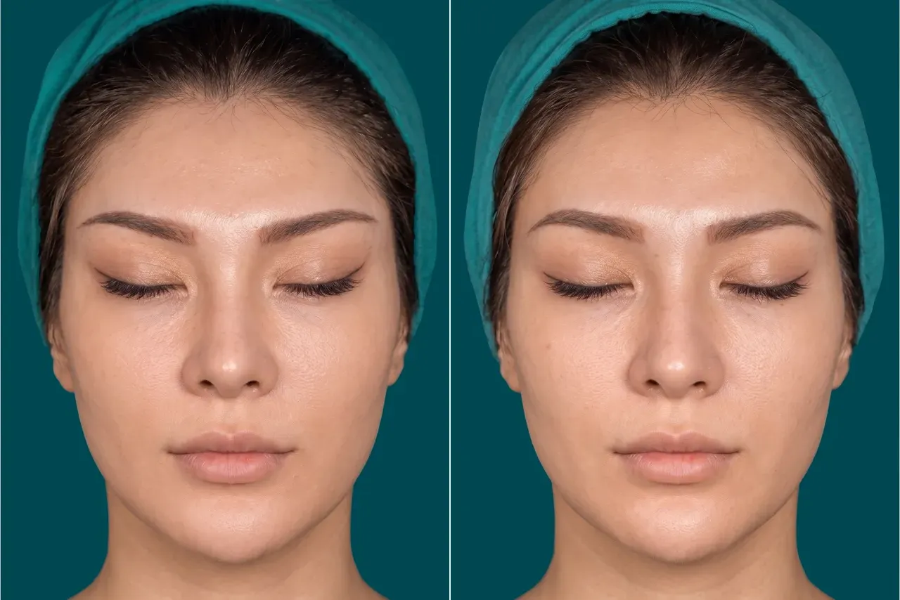 Fox Eye Lift Before and After 3