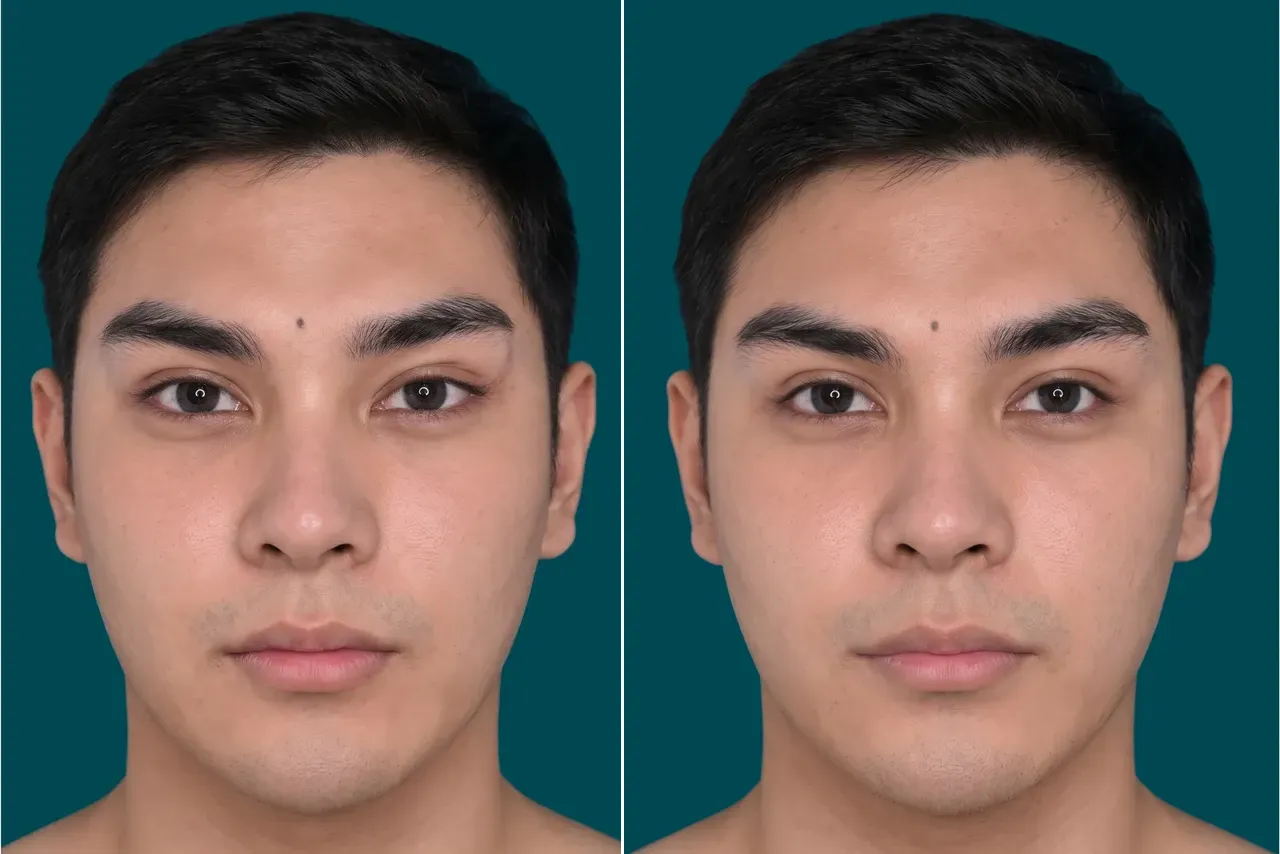 Fox Eye Lift Before and After 5