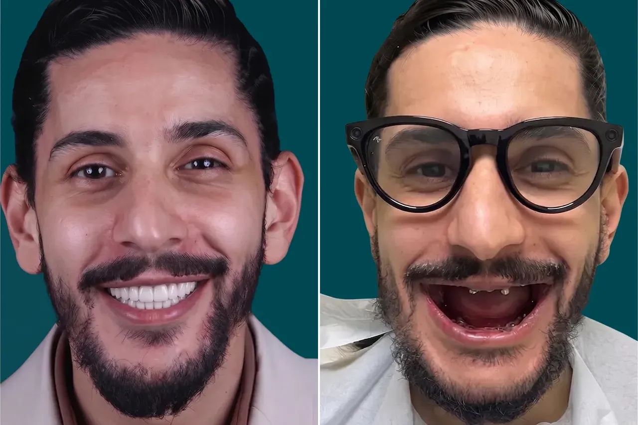 Full-Mouth-Dental-Implants