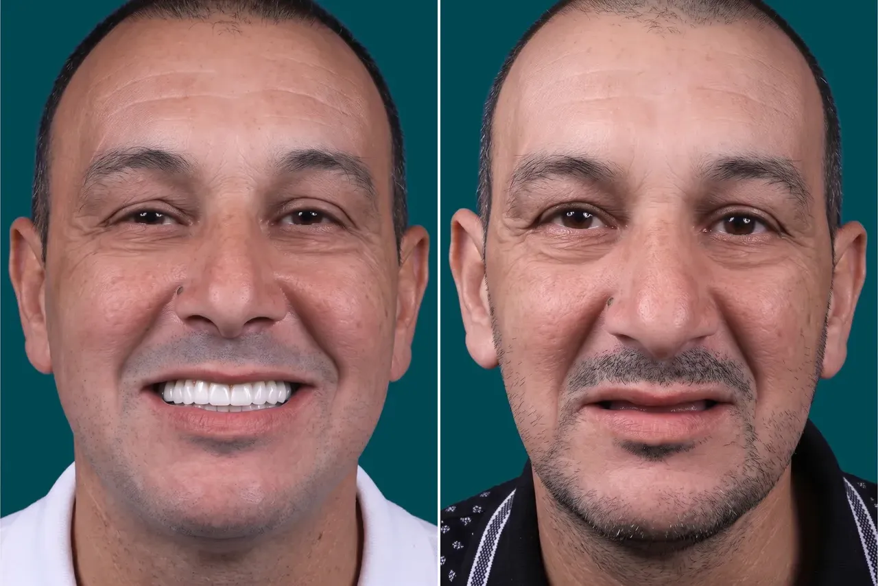 Dental Implants-Full Mouth Dental Implant 2