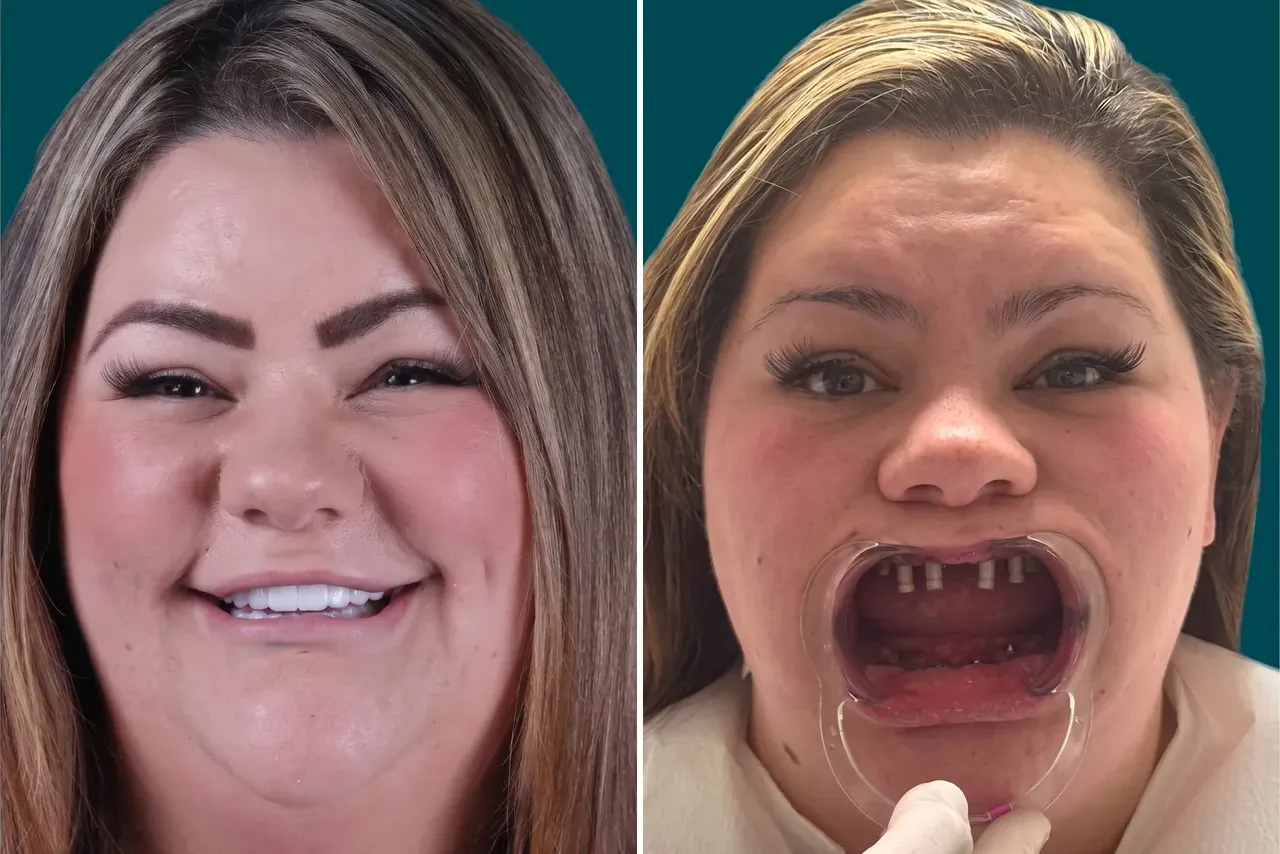 Smile-Makeover-Full-Mouth-Restoration 2