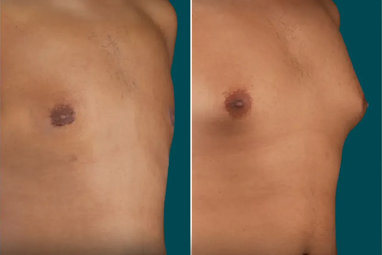 Gynecomastia Surgery Before and After 1