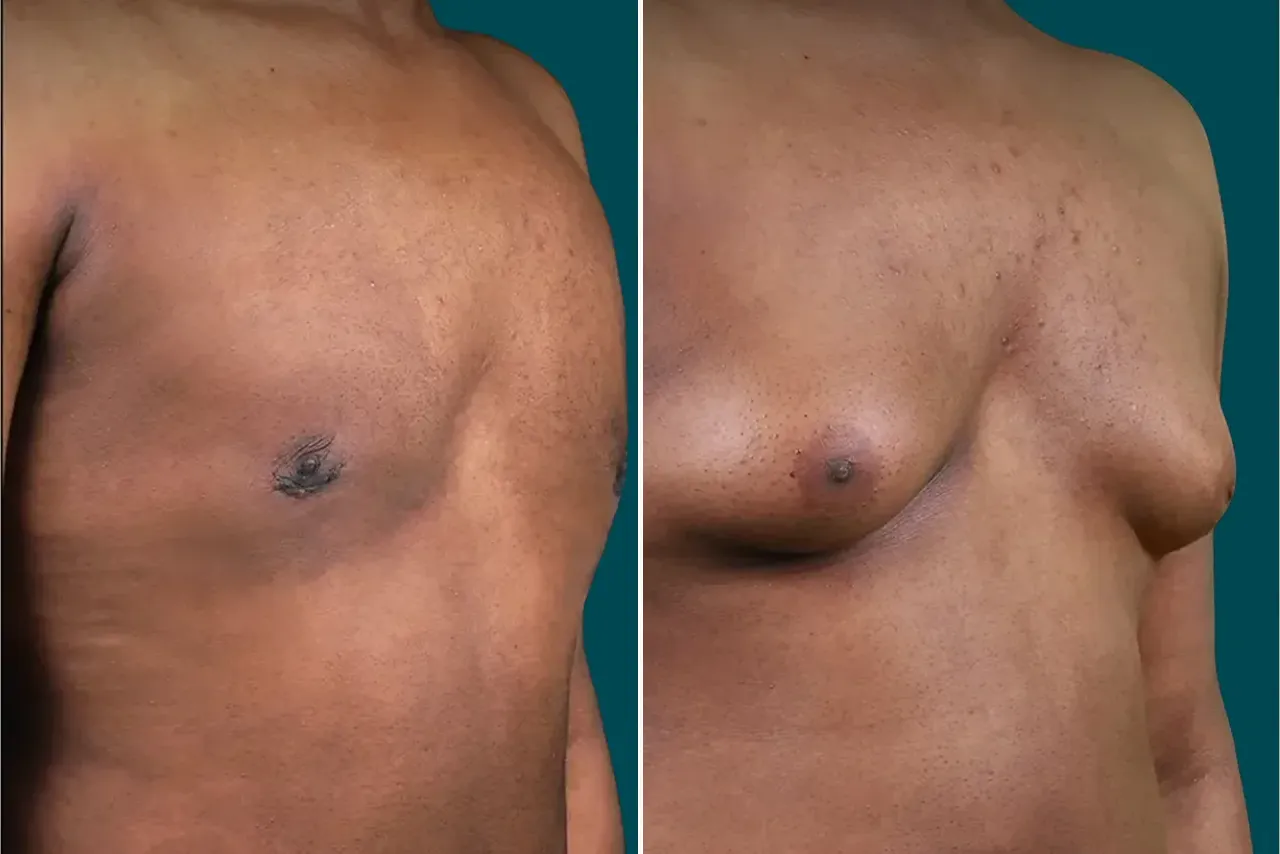 Gynecomastia Surgery Before and After 2