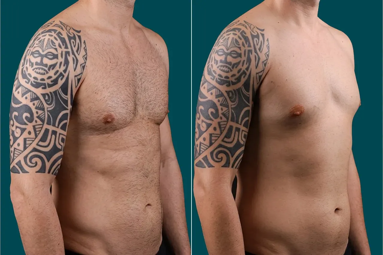 Gynecomastia Surgery Before and After 3