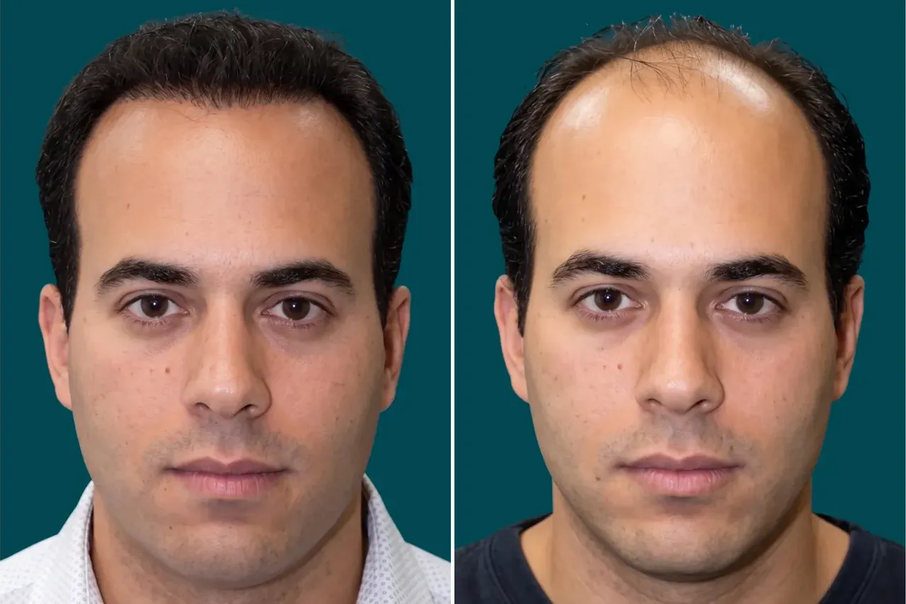 Hair Mesotherapy 2