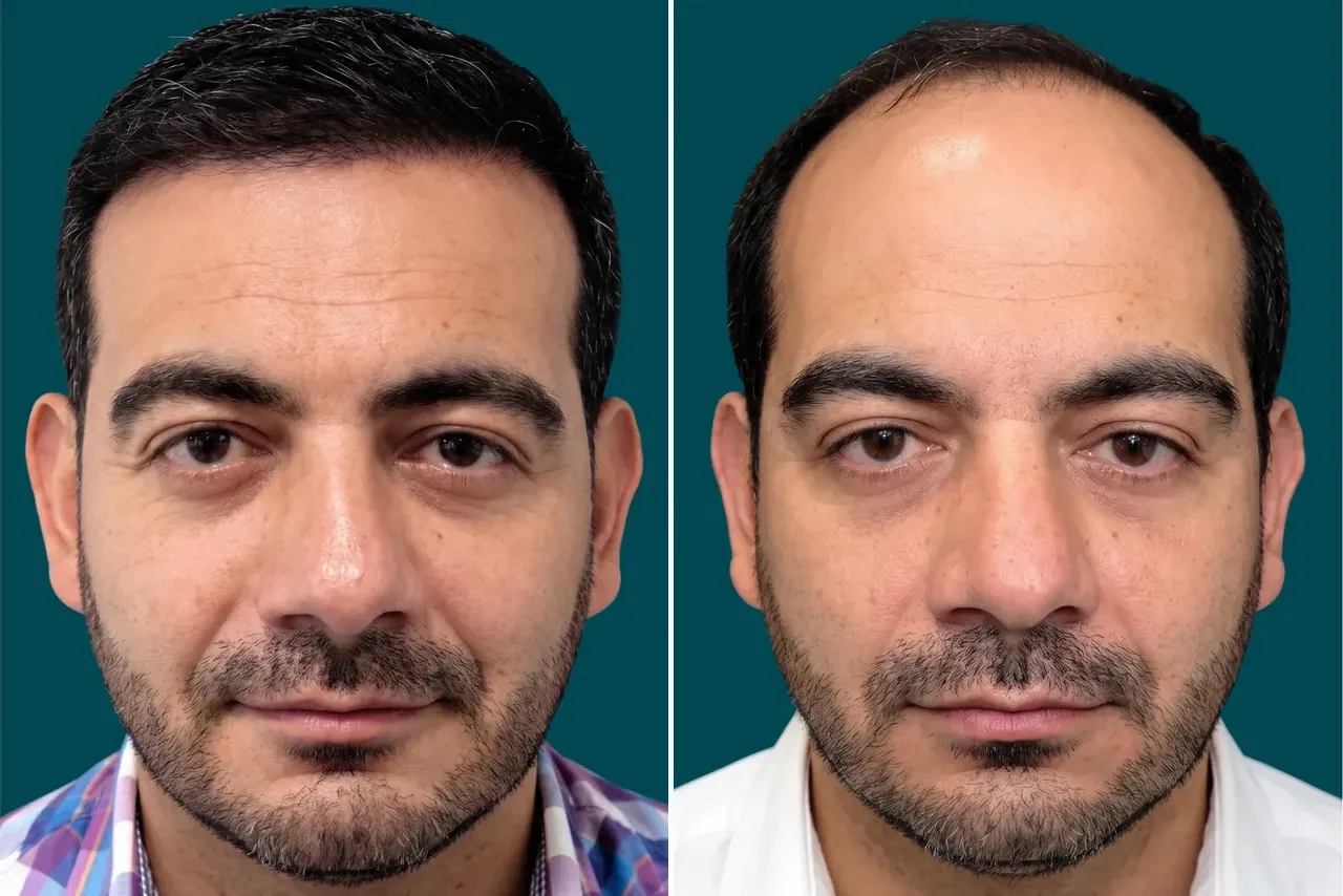Hair Mesotherapy 3