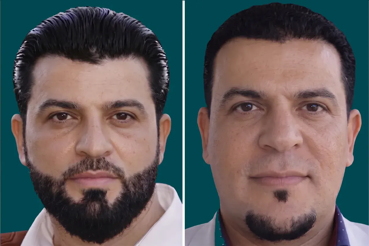 Hair-Transplant-DHI Hair Transplant 5
