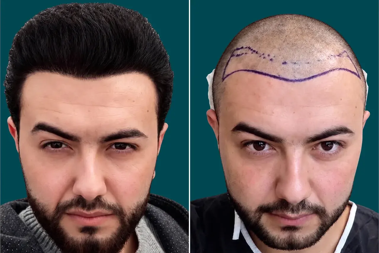 Hair-Transplant-FUT Hair Transplant 3