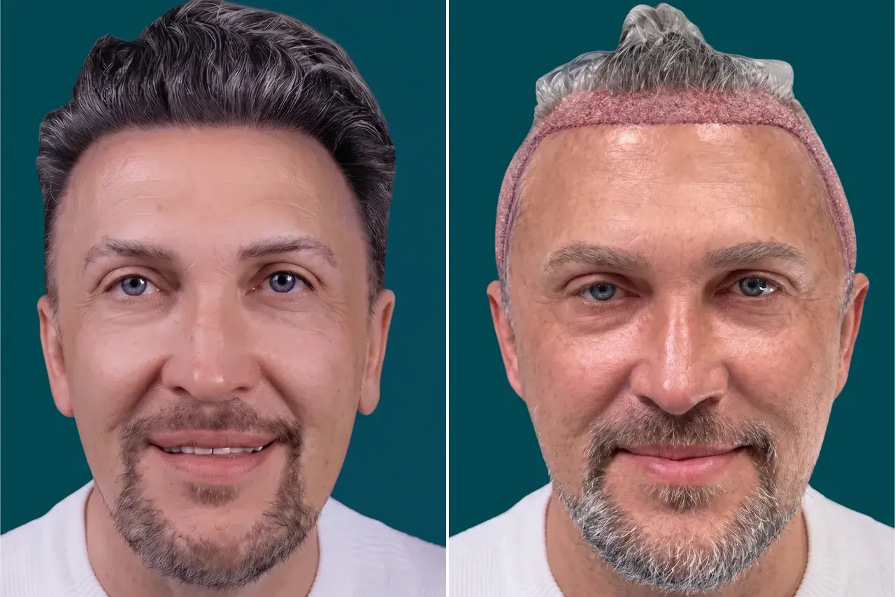 Hair-Transplant-Unshaven Hair Transplant 5