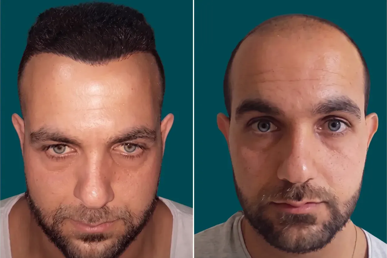 Hair-Transplant-Hybrid Hair Transplant 3