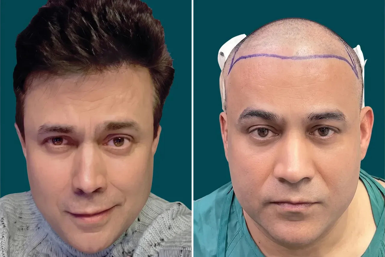 Hair-Treatments-Hair Transplant 8