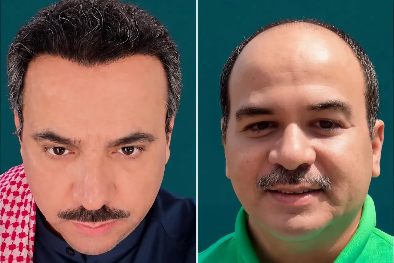 Hair-Transplant-Hybrid Hair Transplant 4