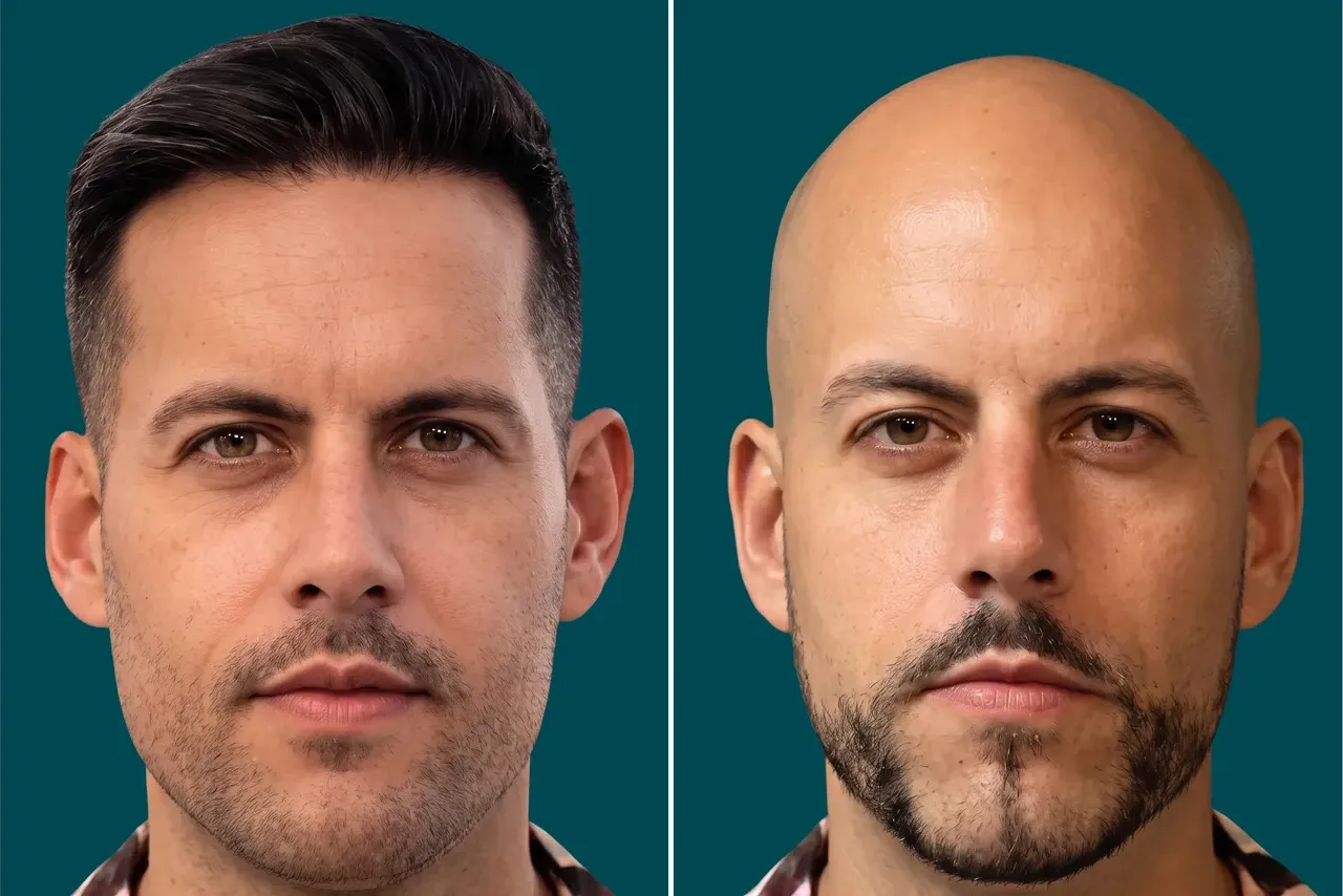 Hair-Treatments-Hair Transplant 7