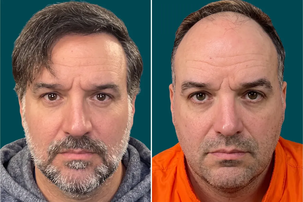 Hair-Treatments-Hair Transplant 6