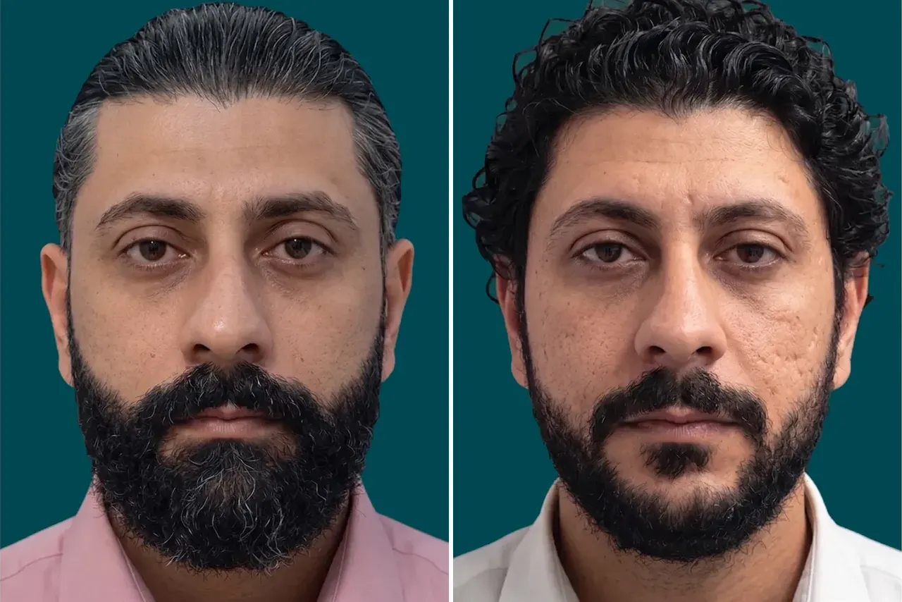 Hair-Treatments-Hair Transplant 10