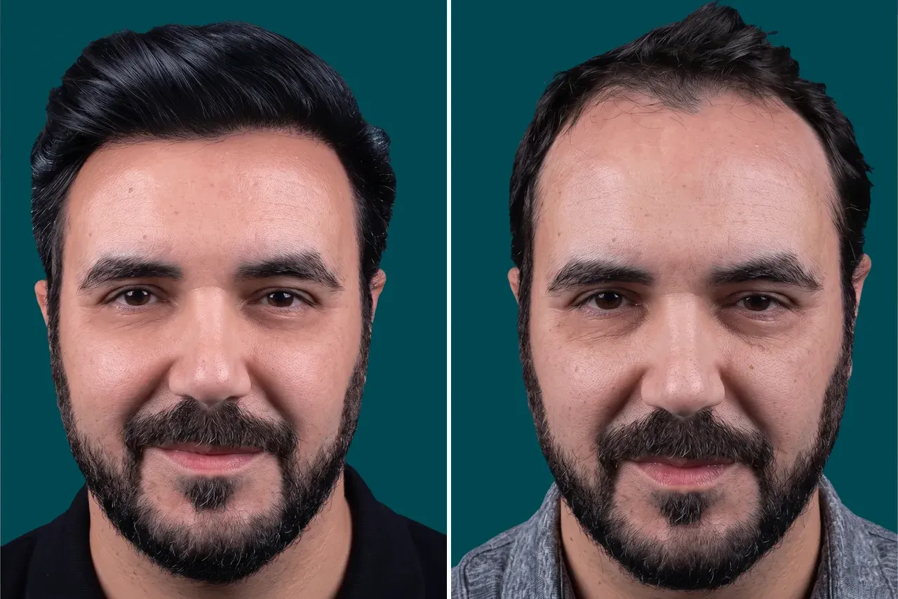 Hair-Transplant-Unshaven Hair Transplant 1
