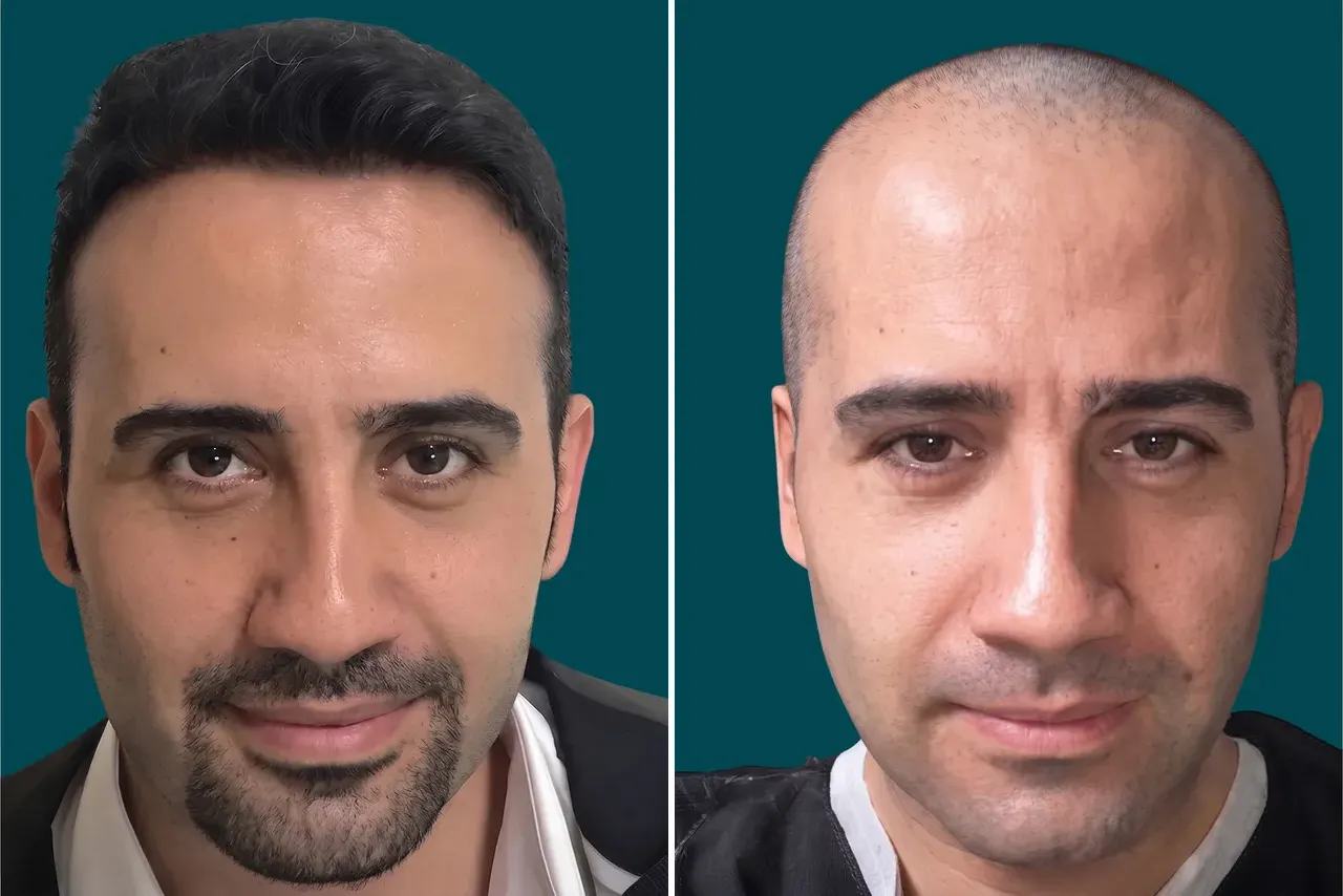 Hair-Transplant-FUT Hair Transplant 4