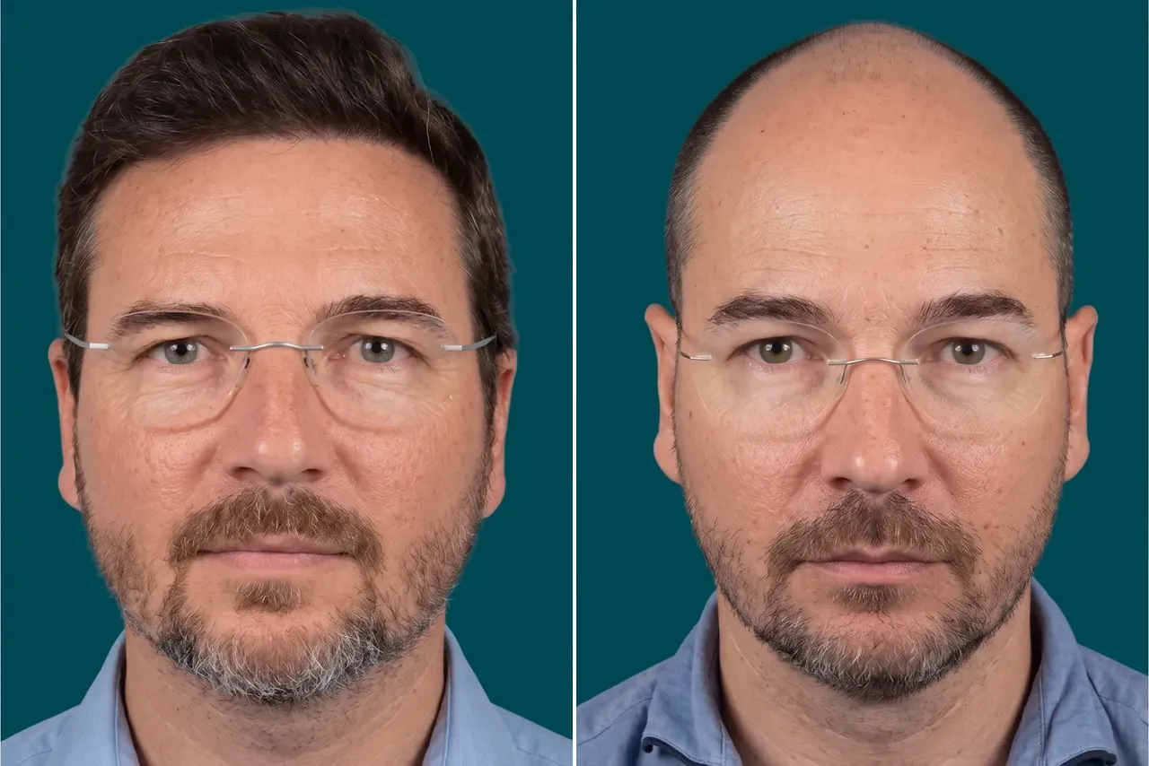 Hair-Transplant-Unshaven Hair Transplant 3