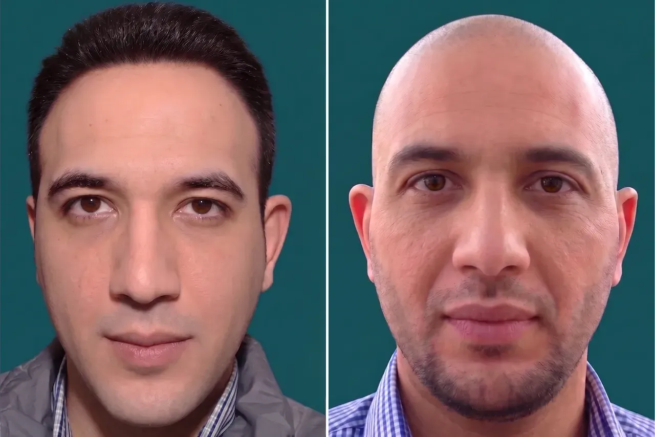 Hair-Transplant-FUT Hair Transplant 5