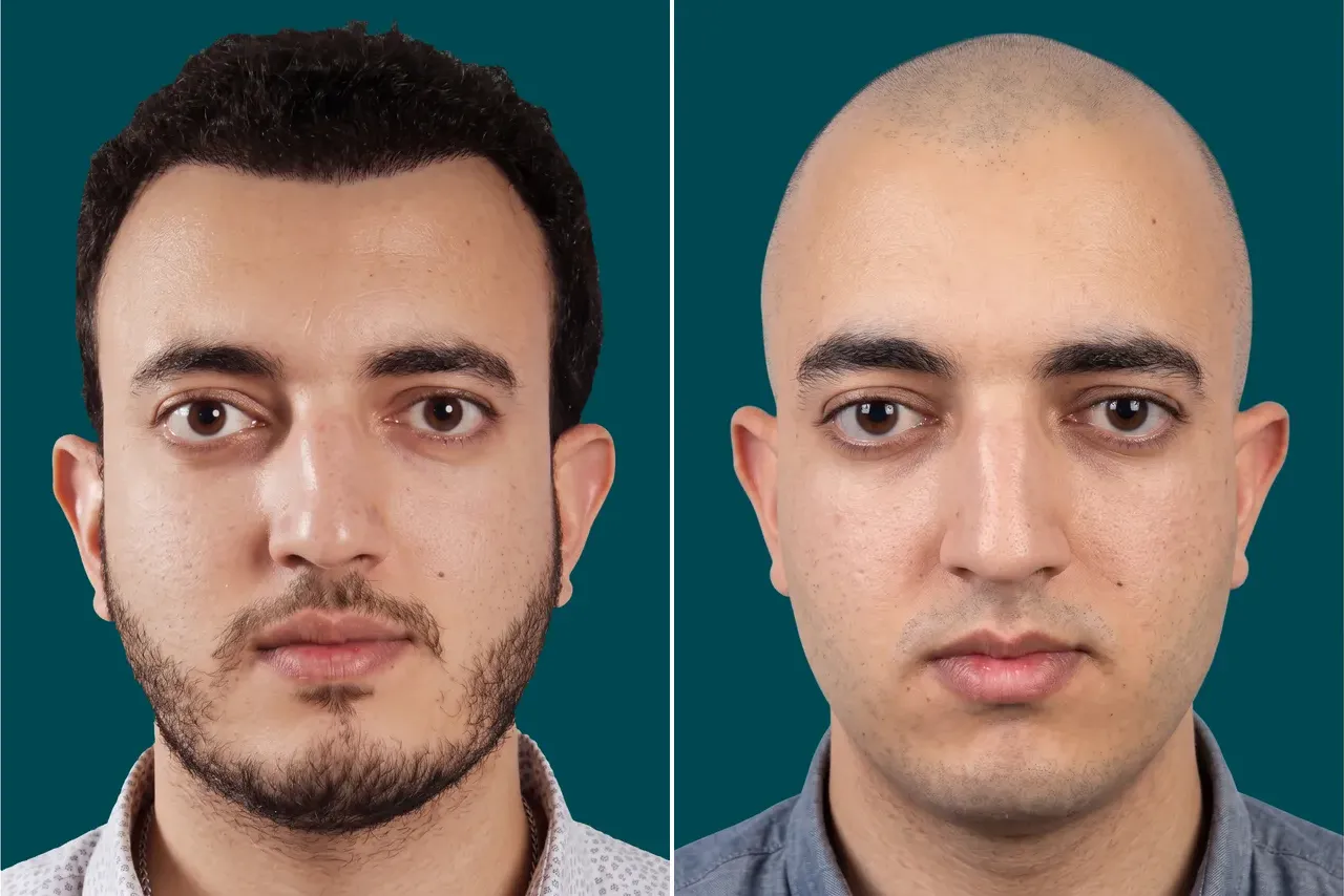 Hair-Transplant-Fue Hair Transplant 2