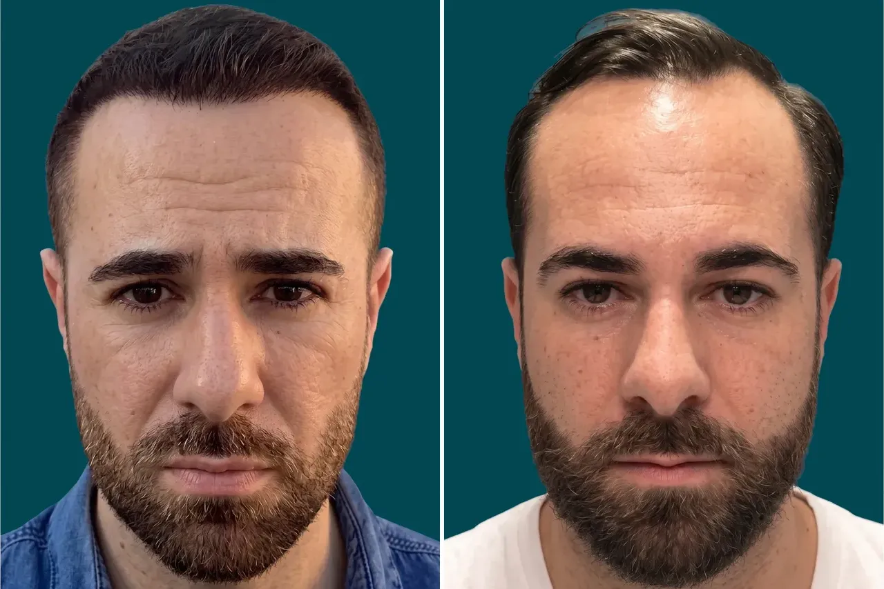 Hair-Transplant-Hybrid Hair Transplant 5