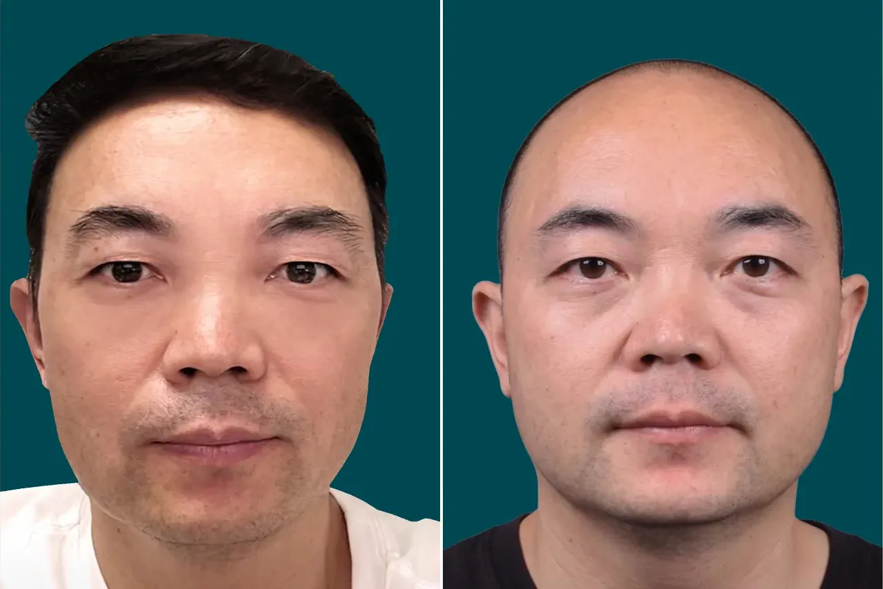 Hair-Transplant-Fue Hair Transplant 4