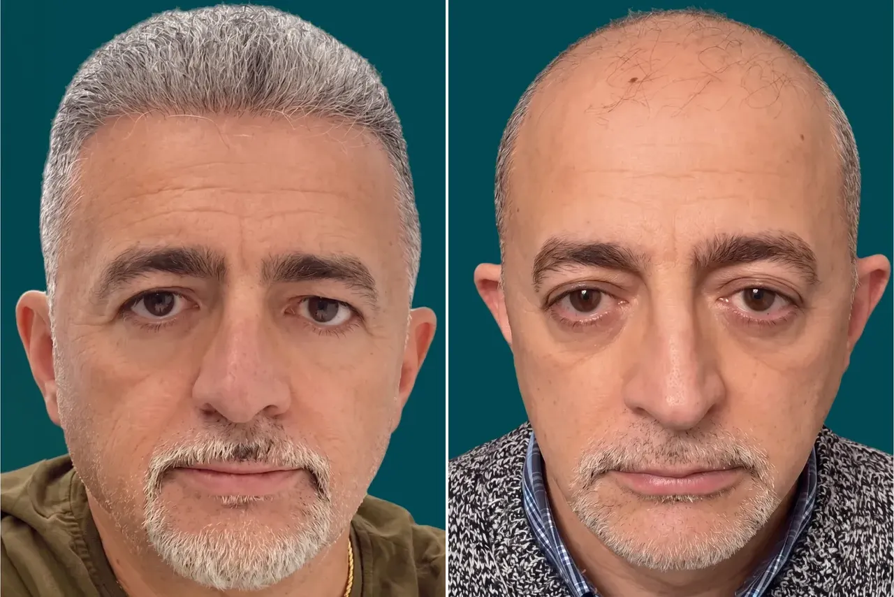 Hair-Transplant-Hybrid Hair Transplant 6