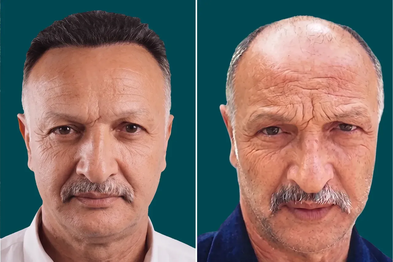 Hair-Transplant-Hybrid Hair Transplant 2