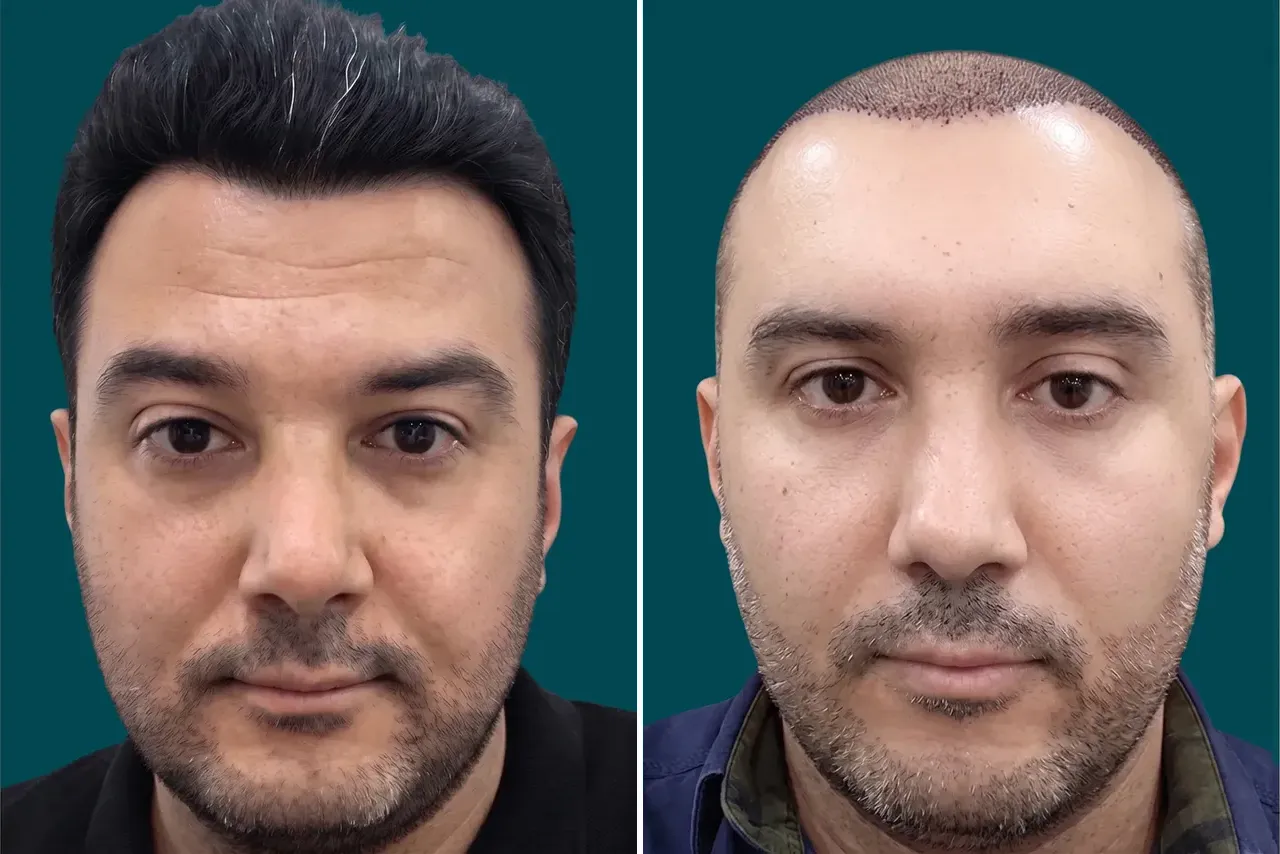 Hair-Transplant-Hybrid Hair Transplant 7