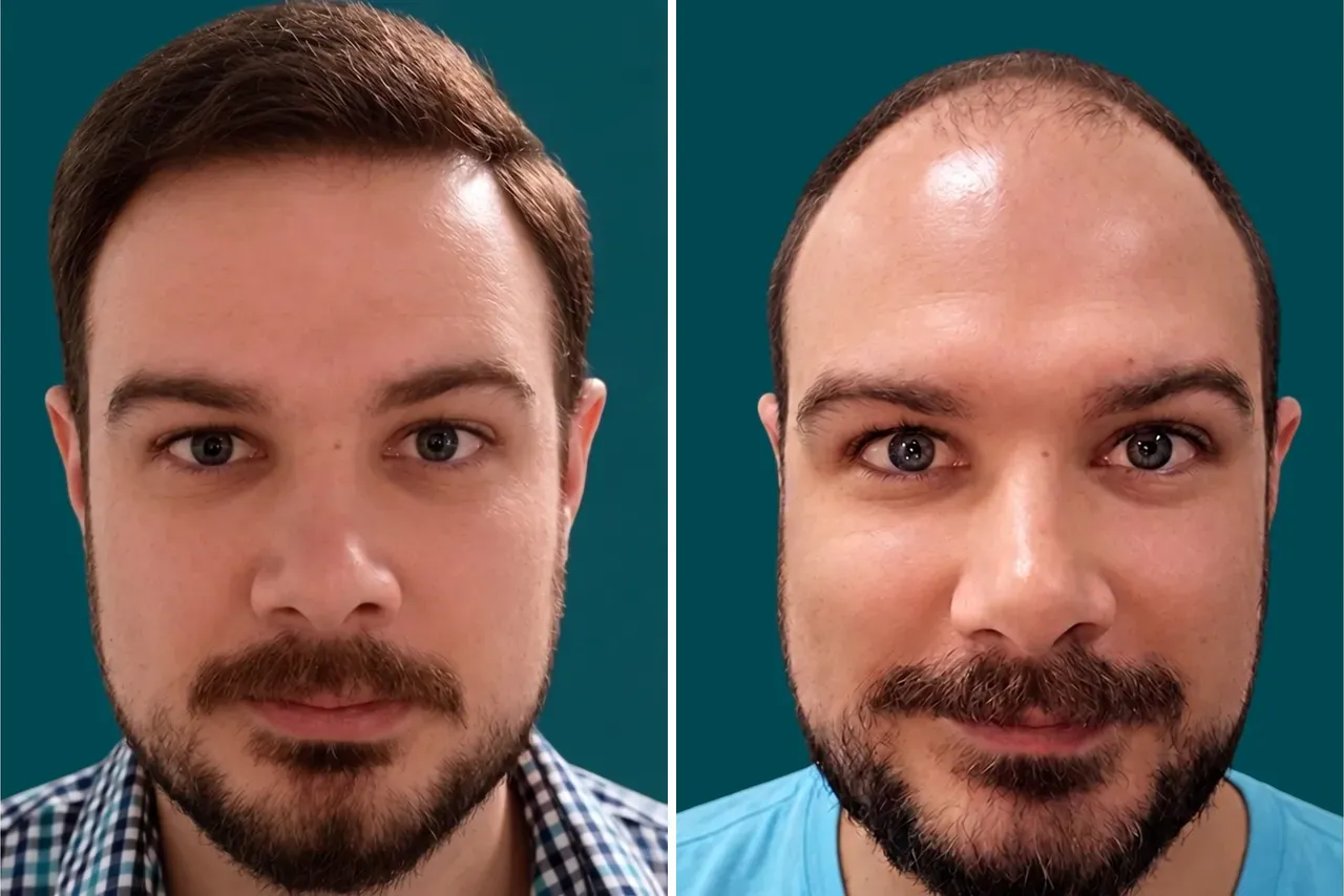 Hair-Transplant-Hybrid Hair Transplant 1