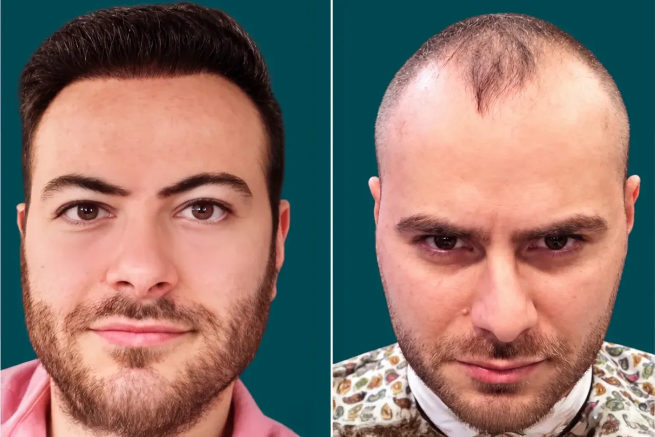 Hair-Treatments-Hair Transplant 13