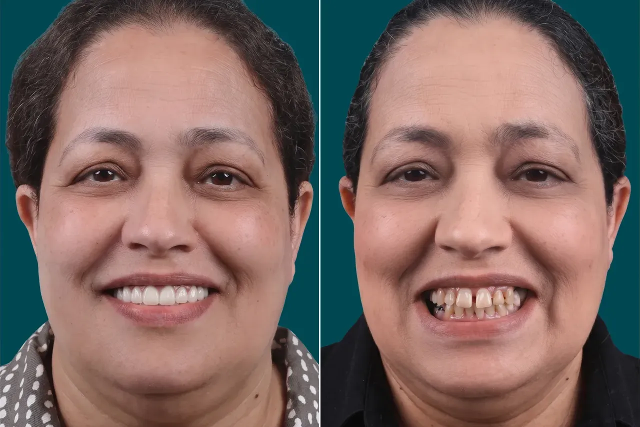 Dental Treatments- Hollywood Smile 