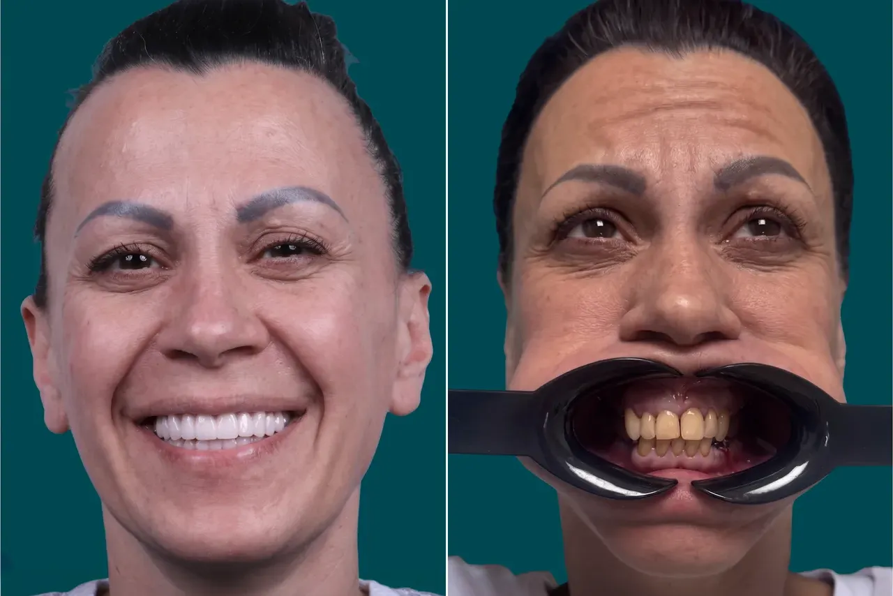 Smile Makeover-Hollywood-Smile 2