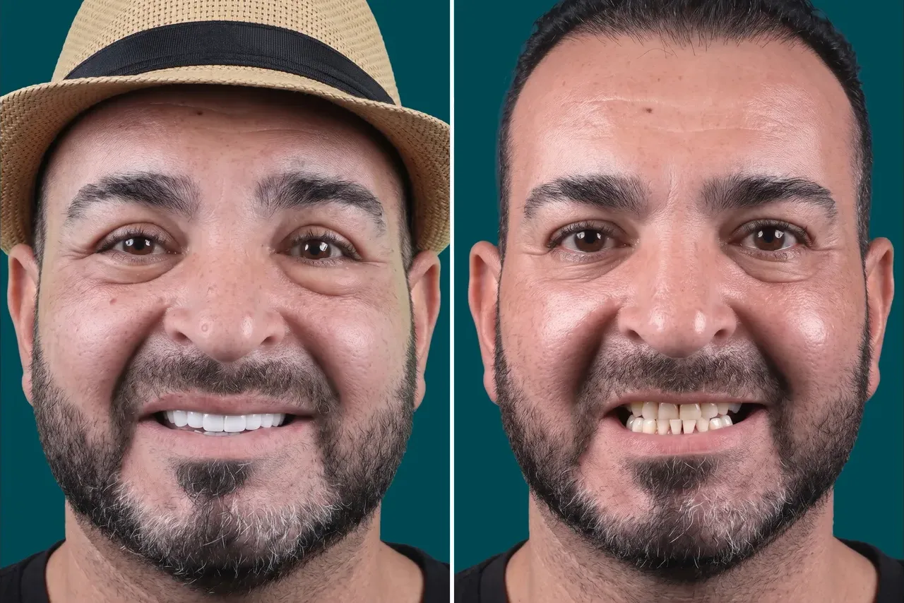 Dental Veneers- LaminateVeneers 2