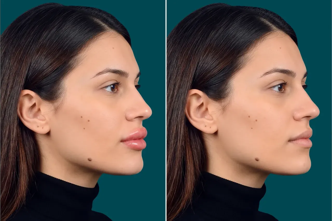 Lip Lift Before and After 2