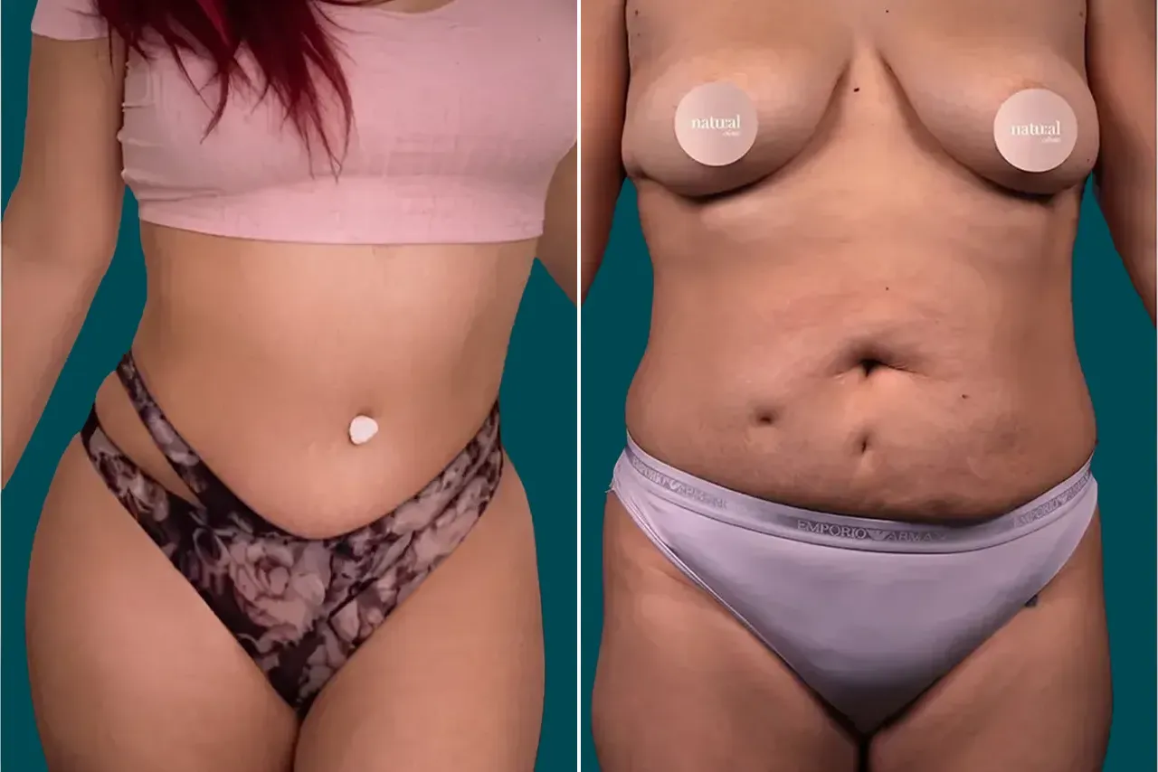 Liposuction Before and After 1