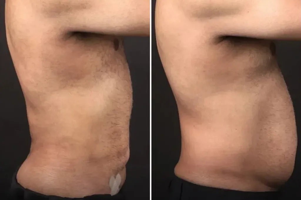 Liposuction1