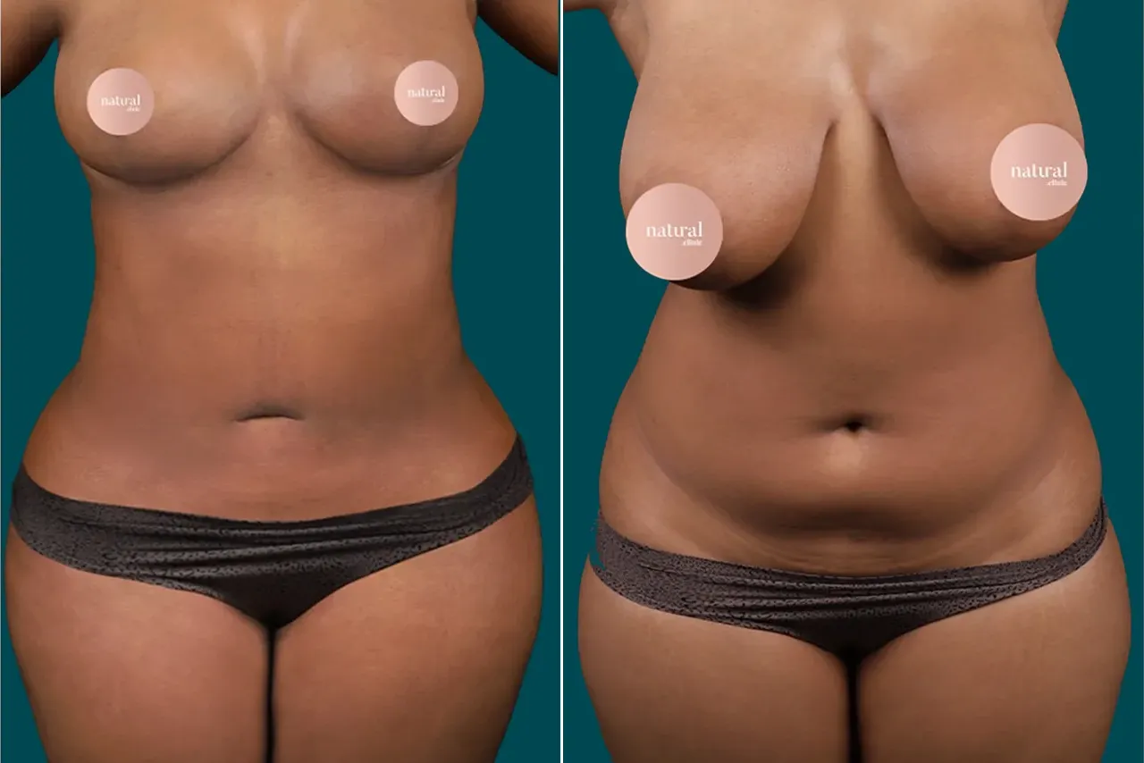 Liposuction Before and After 10
