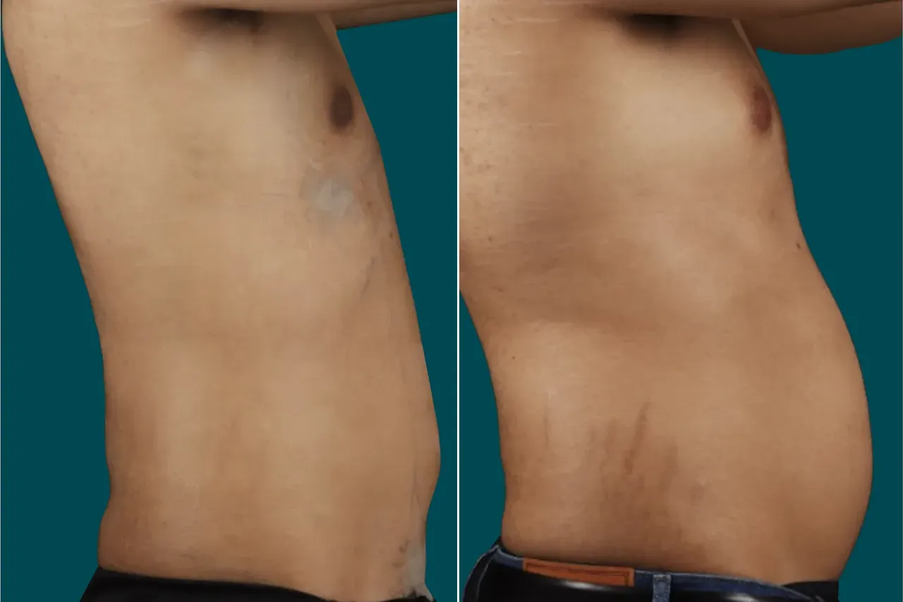 Liposuction Before and After 11